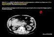 Patient de 67 ans, ATCD de polyarthrite rhumatoïde sous immunosuppresseurs, se présentant aux Urgences pour douleurs abdominales mal systématisées, fièvre