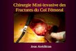 Chirurgie Mini-invasive des Fractures du Col Fémoral Jean Avédikian