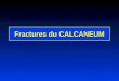Fractures du CALCANEUM. Calcaneum vue interne Articulation sous- astragalienne Grosse tubérosité Sustentaculum