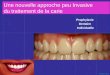 Mblique ©201à Une nouvelle approche peu Invasive du traitement de la carie Prophylaxie Dentaire Individuelle ou « PDI »