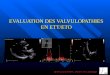 EVALUATION DES VALVULOPATHIES EN ETT/ETO Dr Franck HAZIZA. Service de Cardiologie