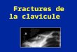 Fractures de la clavicule. •Fréquentes chez l’enfant (30% des fractures) •Chutes sur la main ++ •Chocs directs sur l’épaule