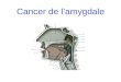 Cancer de l'amygdale