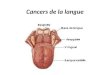 Cancer de la langue