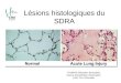 Lésions histologiques du SDRA