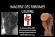 IMAGERIE DES FIBROMES UTERINS - .The response of uterine fibroids to embolization in the African