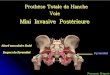 Mini Invasive Postérieure - Chirurgie mini invasive de hanche … · Abord musculaire limité . é Respect du Pyramidal . Respect du Pyramidal. Pyramidal. Prothèse Totale de Hanche