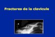 Fractures de la clavicule - IFSI DIJON Bienvenue - IFSI … · - L’épaule s’affaisse (poids, pectoral) ... Broche Acr-clav temporaire Laçage entre clavicule et coracoïde. Fin