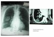 Tumeur/Syndrome PARIETALE - Respir du Sud · cheveux Oreilles bas implantées et orientées en arrière ... représente l'anomalie la plus fréquente (80%) CA V, coarctation aortique,