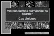 Micronodulation pulmonaire au scanner Cas cliniquesonclepaul.fr/wp-content/uploads/2011/07/Syndrome-micronodulaire-.pdf · Cas cliniques. Définition Micronodules, Nodules, Masses