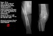 ATCD : fracture fémorale âge de 12 ans, …onclepaul.net/wp-content/uploads/2011/07/omaFILEminimizer1.pdf · tissu de granulation inflammatoire du pourtour des lésions abcèdées