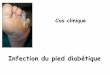 Infection du pied diabétique - criogo.fr · membre inférieur gauche, fièvre, frissons ... • Artères fémorales commune et profonde de calibre régulier sans surcharge athéromateuse