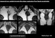 Homme de 35 ans, maladie de Crohn iléo colique ...onclepaul.net/wp-content/uploads/2011/07/fistules-ano-périnéales... · Examen clinique et échographie endo anale Sonde endorectale