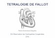 T©tralogie de Fallot - .ETIOLOGIES Syndrome de Di GEORGE Syndrome dâ€™alcoolisme f“tal (SAF) Syndrome