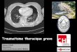 Traumatisme thoracique grave - secours- · PDF fileCAT hémothorax Drainage ... diminuer les douleurs liées aux fractures déplacées et baisse de consommation opiacés prévenir