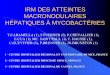 IRM DES ATTEINTES MACRONODULAIRES …pe.sfrnet.org/Data/ModuleConsultationPoster/pdf/2006/1/2e0d58cd-3a... · ont été identifiés en croisant les listings des IRM hépatiques et
