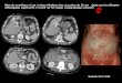 Bilan de surveillance d une cirrhose éthylique chez un patient de …onclepaul.net/wp-content/uploads/2011/07/crubaFILE... · 2012-12-30 · • Le Syndrome de Cruveilhier-Baumgarten