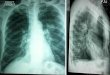 Traumatismes thoraciques : 12 lésions potentiellement létales. · pneumothorax en salle de déchoquage chez le patient polytraumatisé (1)(2) • L'échographie peut permettre le