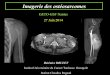 GETO-GSF Nantes 27 Juin 2014journees-gsf.fr/files/70/calendrier/04-boulet-gsf-2014-osteosarcome.… · - sarcome : tumeur mésenchymateuse maligne Différents contingents DES ostéosarcomes