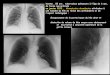homme , 55 ans , tuberculose pulmonaire à l'âge de 6 ans ...onclepaul.net/wp-content/uploads/2011/07/behan.pdf · homme , 55 ans , tuberculose pulmonaire à l'âge de 6 ans, de