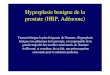 Hyperplasie benigne de la prostate (HBP, Ad£©nome) ... prostate (HBP, Ad£©nome) Tumeur b£©nigne la plus