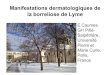 Manifestations dermatologiques de la borreliose de Lyme...1) il n’y a, à priori, pas de maladie de Lyme en Corse…. 2) la dose recommandée d’amoxicilline, au cas ou cela eut
