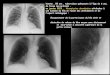 homme , 55 ans , tuberculose pulmonaire à l'âge de 6 ans, de ...onclepaul.fr/wp-content/uploads/2011/07/Behcet-sd-de...maladie de Behcet , elle se caractérise par l'association
