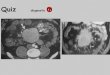 Quiz diagnostic - ONCLE PAULonclepaul.fr/wp-content/uploads/2011/07/QUUIZZ-GILLES-G... · 2016. 2. 29. · •lymphome (non hodgkinien) Ref : Abd Imaging, 1997, 22 : 248-252, Farman