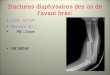 fractures des deux os de l’avant bras - univ-setif.dz · 2020. 4. 23. · propre aux FR diaphysaires de l'avant bras, cependant la classification de l'AO(1990) appliquée pour toutes
