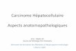 Carcinome Hépatocellulaire Aspects anatomopathologiques