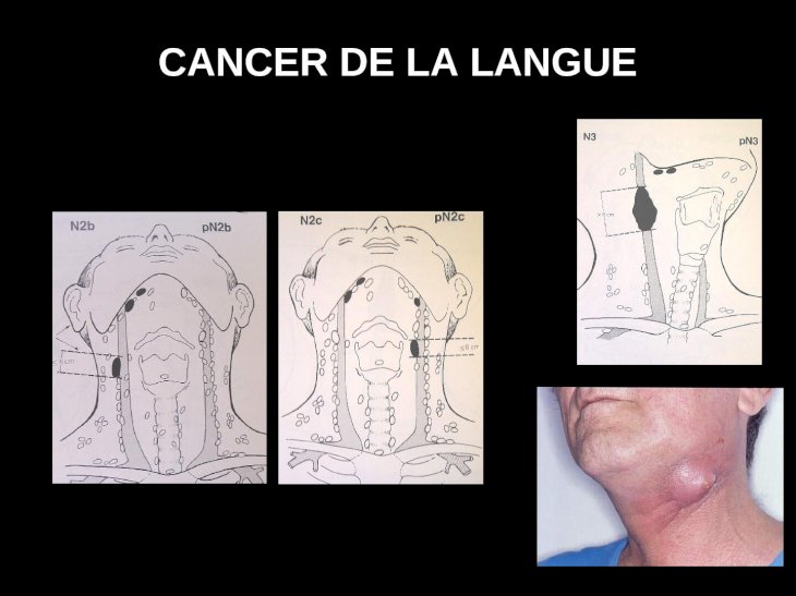 Ppt Cancer De La Langue Tnm Cancer De La Langue 6 Evolution